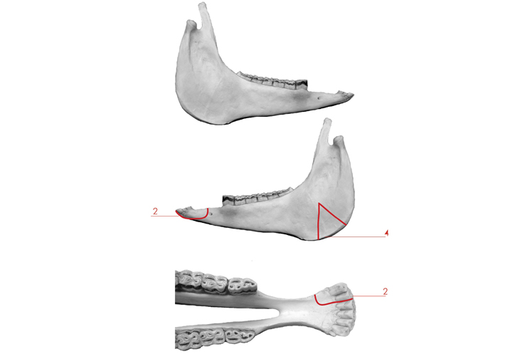 type 3 mandibular bone height