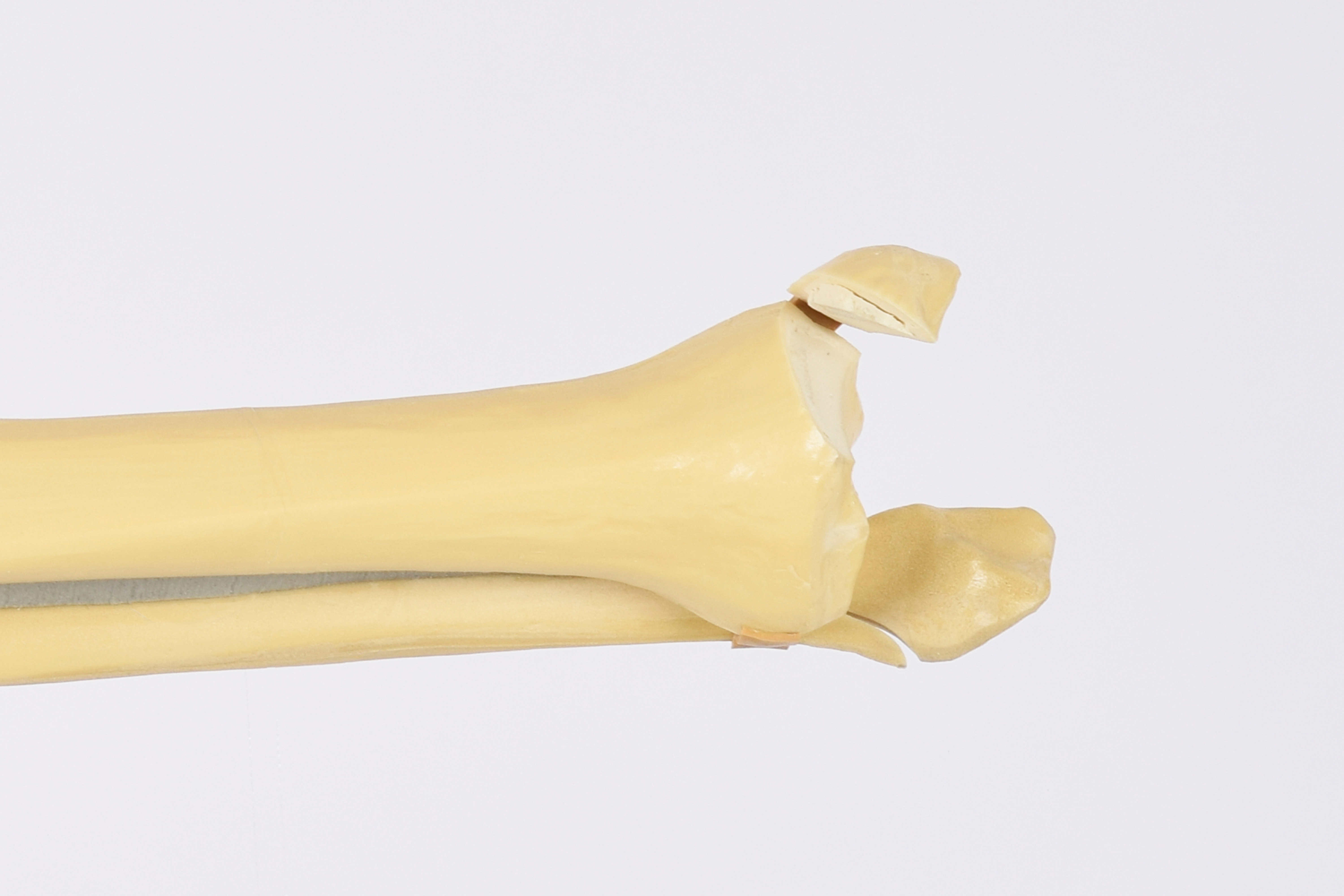 Synthes Expert Tibial Nail Nail Ftempo